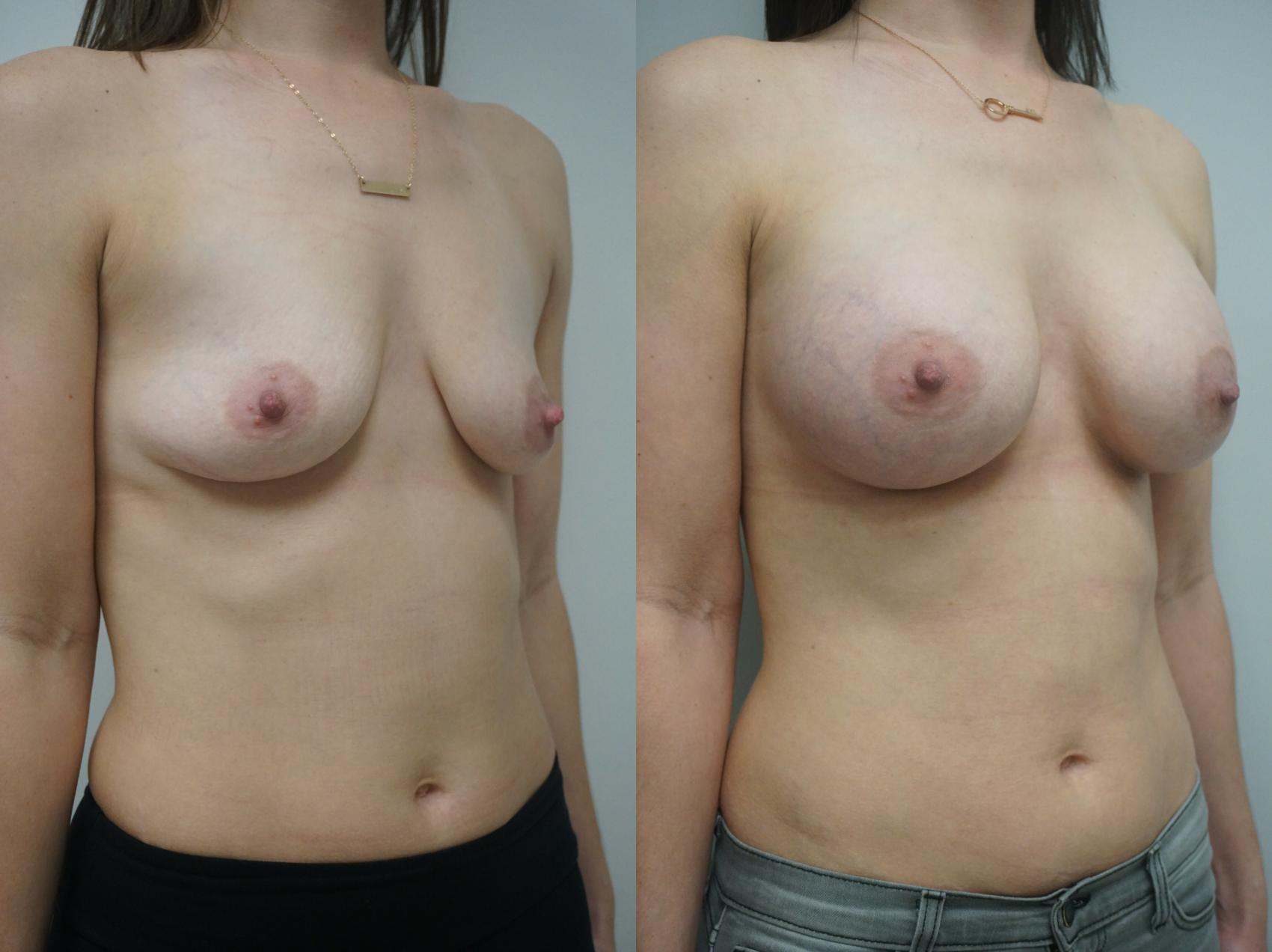 Before & After Breast Augmentation Case 243 View #2 View in Gilbert, AZ