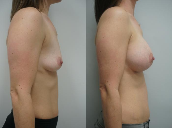 Before & After Breast Augmentation Case 243 View #3 View in Gilbert, AZ