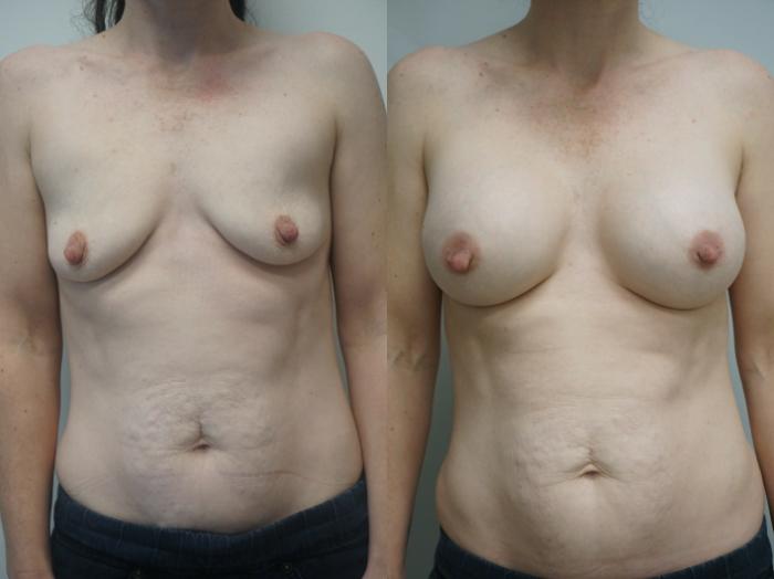 Before & After Breast Augmentation Case 244 View #1 View in Gilbert, AZ