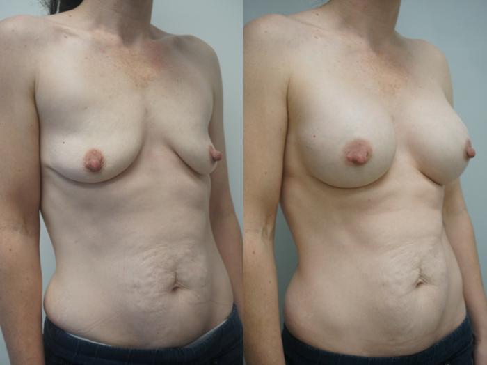Before & After Breast Augmentation Case 244 View #2 View in Gilbert, AZ