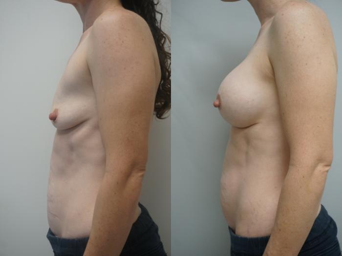 Before & After Breast Augmentation Case 244 View #3 View in Gilbert, AZ