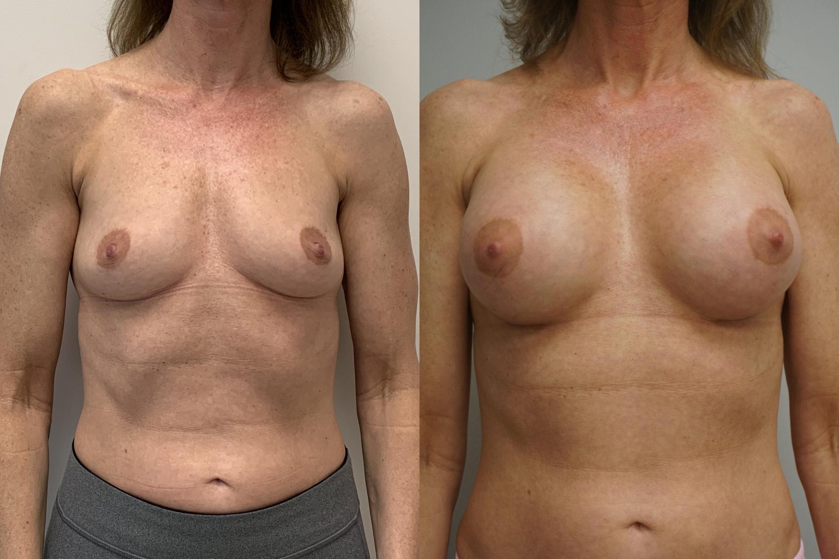 Before & After Breast Augmentation Case 247 View #1 View in Gilbert, AZ