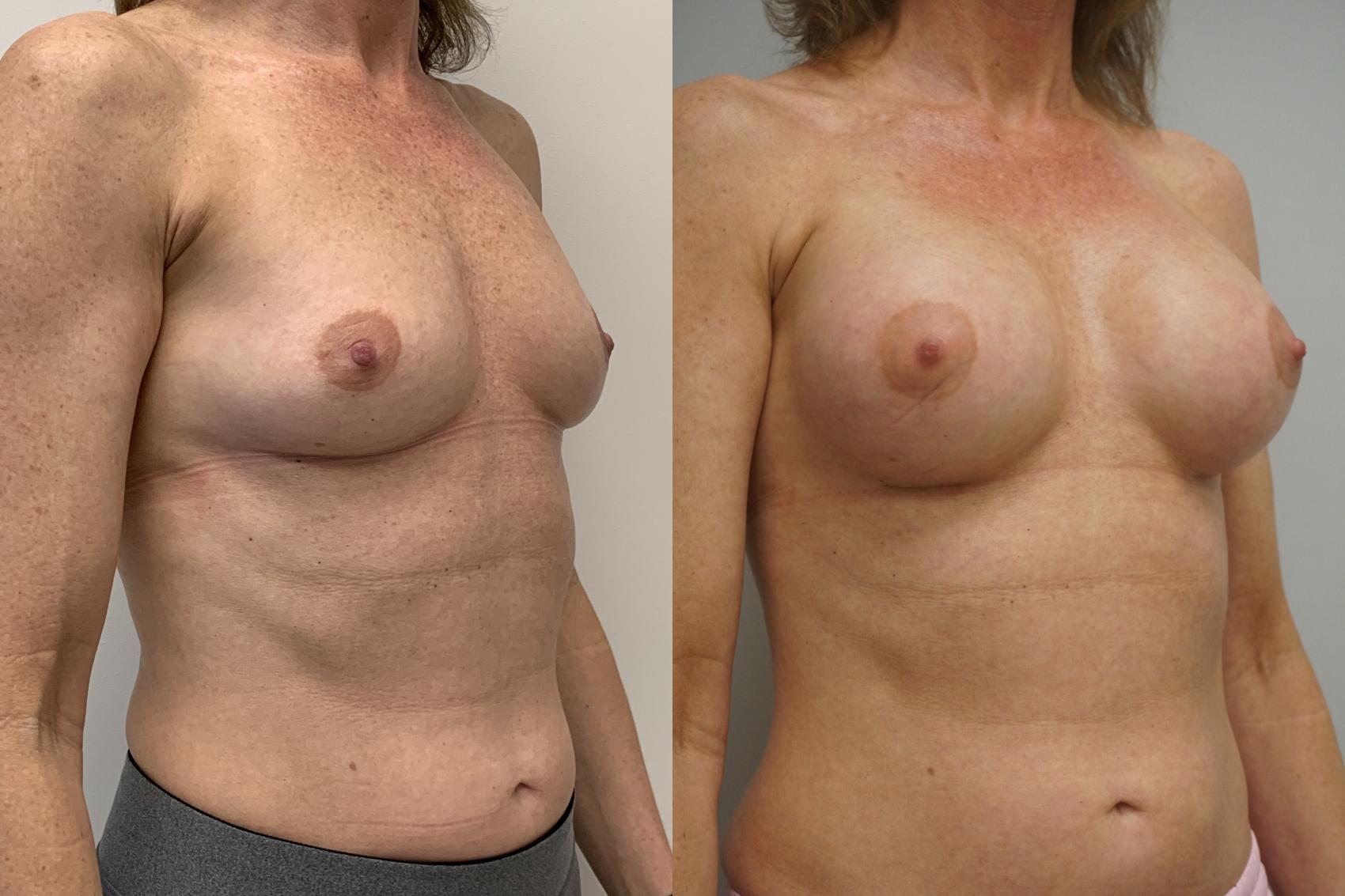 Before & After Breast Augmentation Case 247 View #2 View in Gilbert, AZ