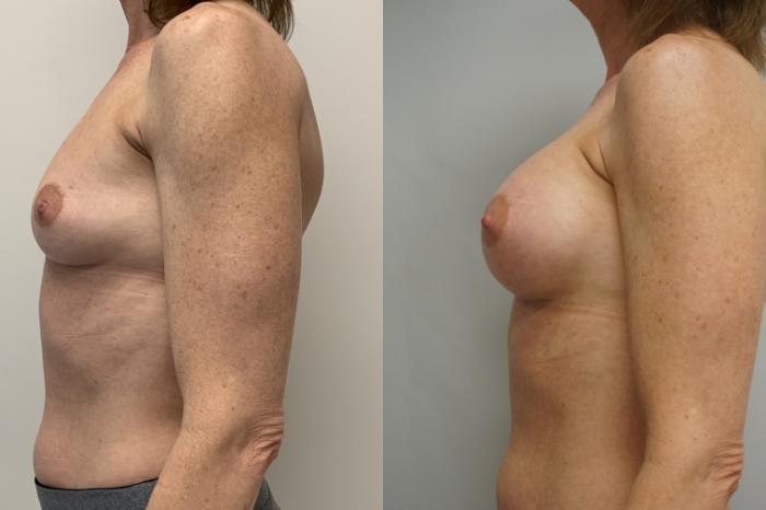 Before & After Breast Augmentation Case 247 View #3 View in Gilbert, AZ