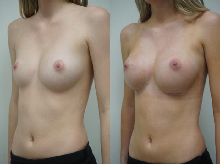 Before & After Breast Augmentation Case 252 View #1 View in Gilbert, AZ