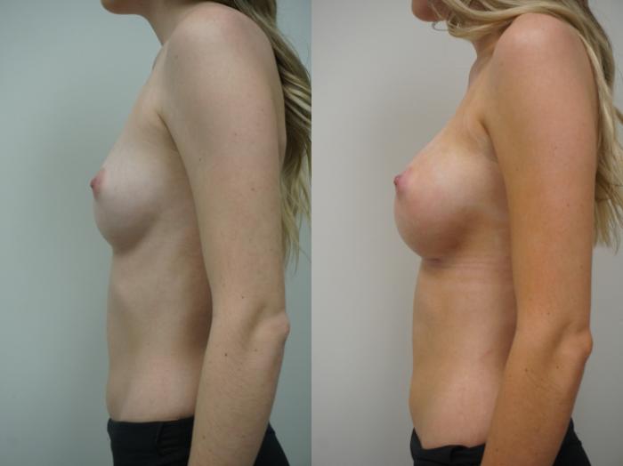 Before & After Breast Augmentation Case 252 View #2 View in Gilbert, AZ