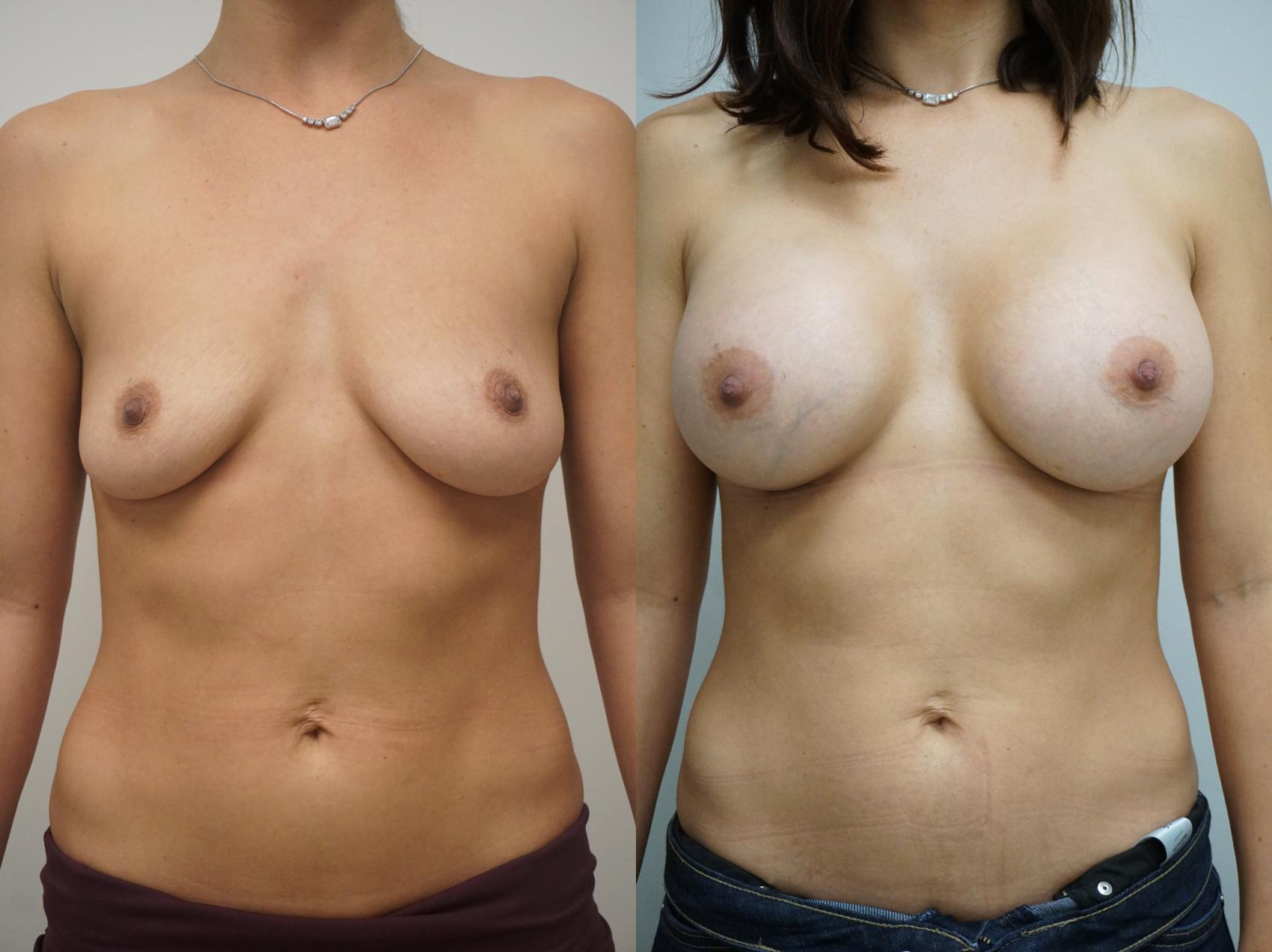 Before & After Breast Augmentation Case 255 View #1 View in Gilbert, AZ