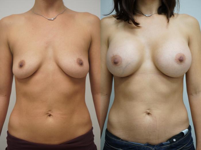Before & After Breast Augmentation Case 255 View #1 View in Gilbert, AZ