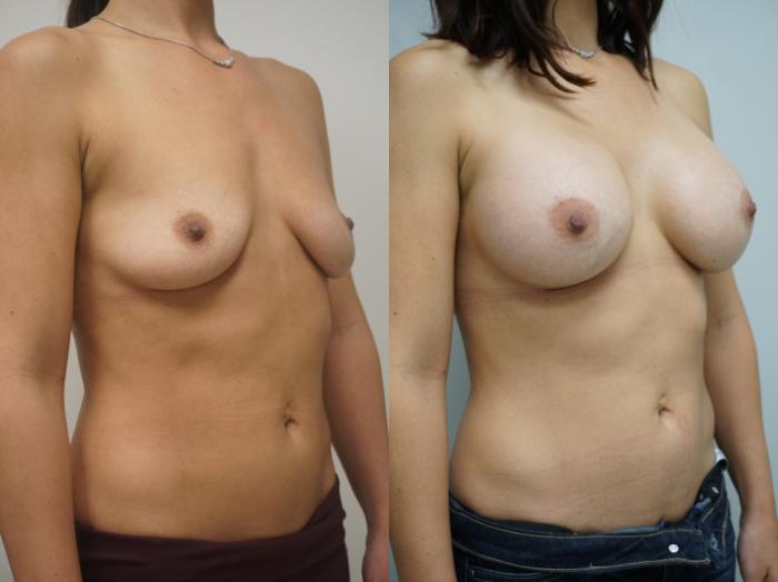 Before & After Breast Augmentation Case 255 View #2 View in Gilbert, AZ