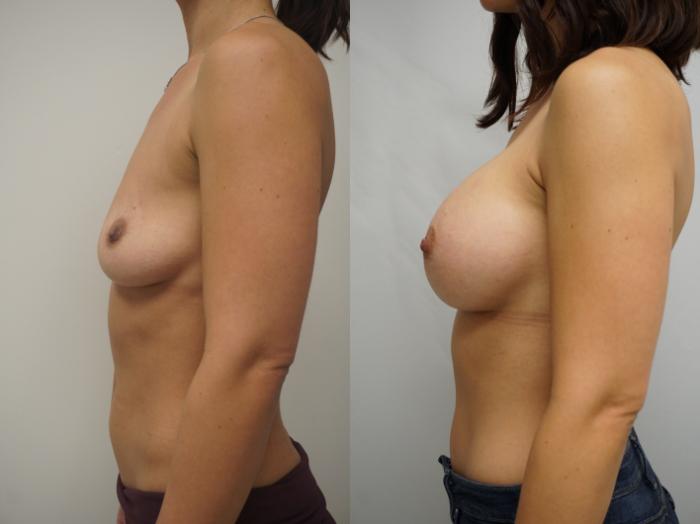 Before & After Breast Augmentation Case 255 View #3 View in Gilbert, AZ