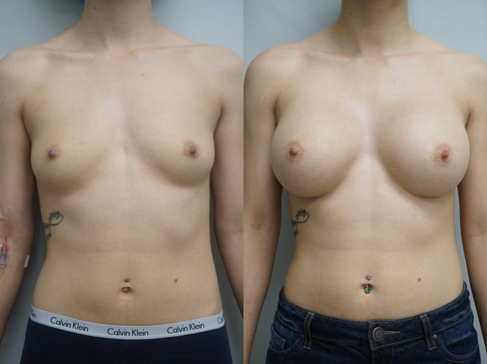 Before & After Breast Augmentation Case 257 View #1 View in Gilbert, AZ