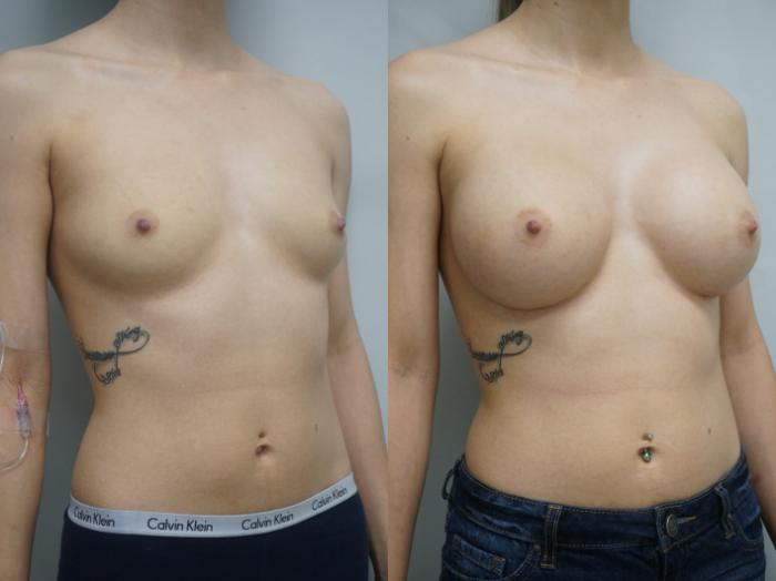 Before & After Breast Augmentation Case 257 View #2 View in Gilbert, AZ