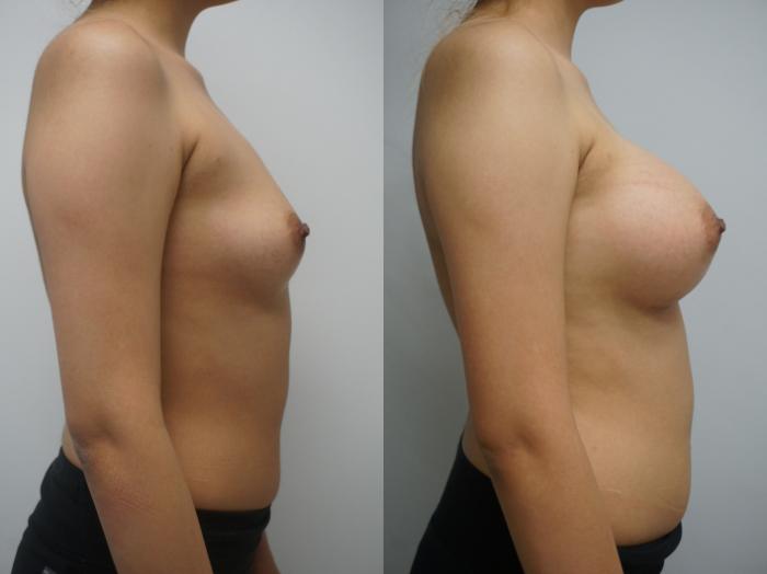 Before & After Breast Augmentation Case 259 View #1 View in Gilbert, AZ