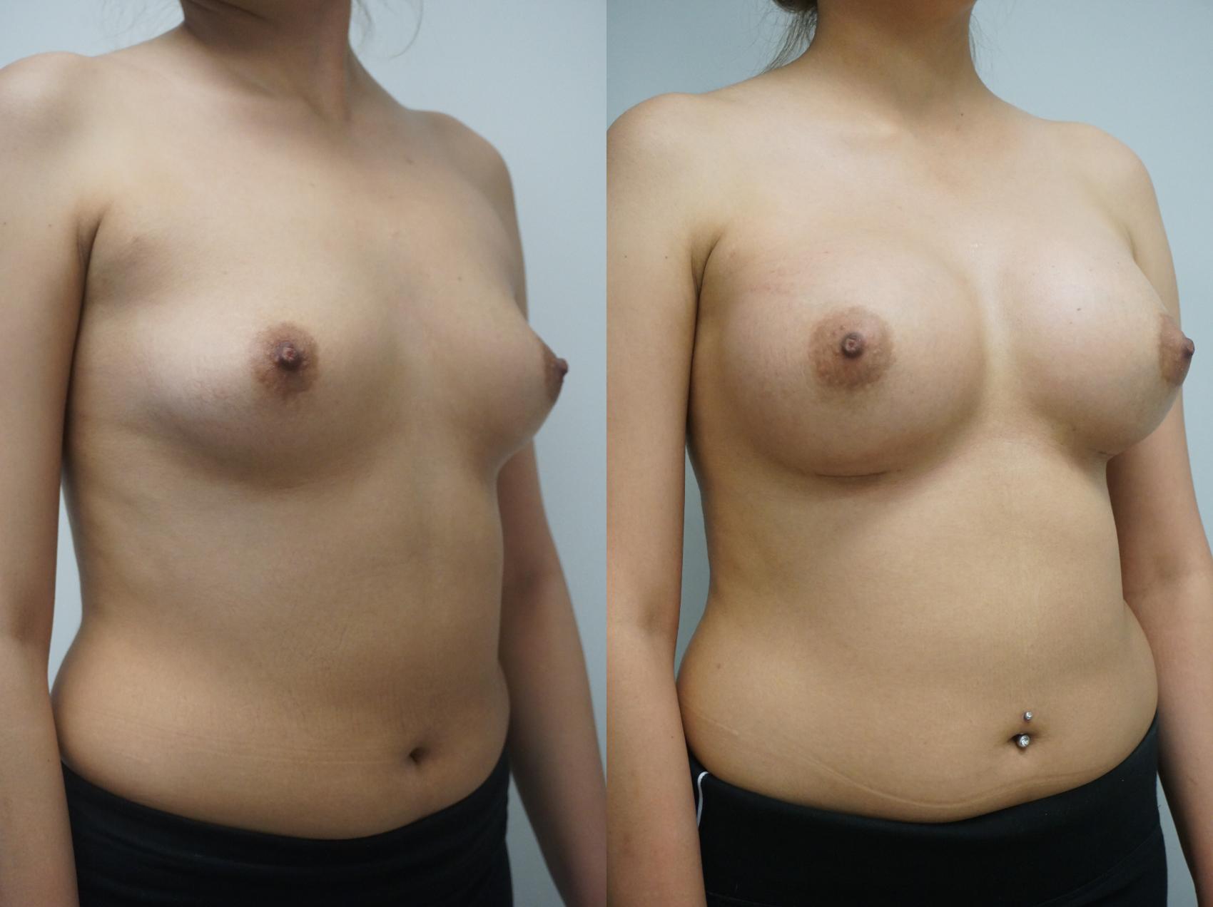 Before & After Breast Augmentation Case 259 View #2 View in Gilbert, AZ