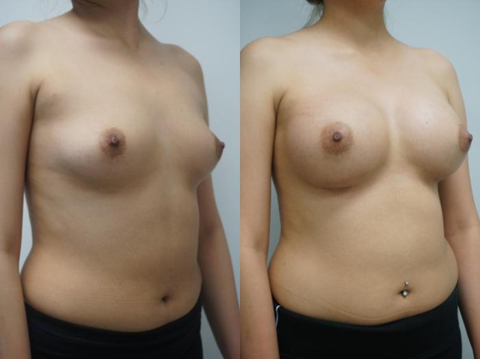 Before & After Breast Augmentation Case 259 View #2 View in Gilbert, AZ