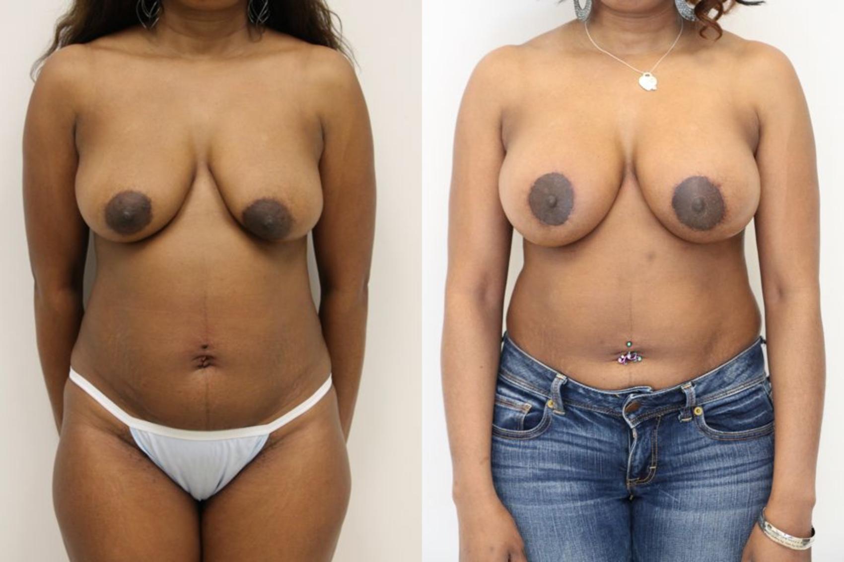 Before & After Breast Augmentation Case 26 View #1 View in Gilbert, AZ
