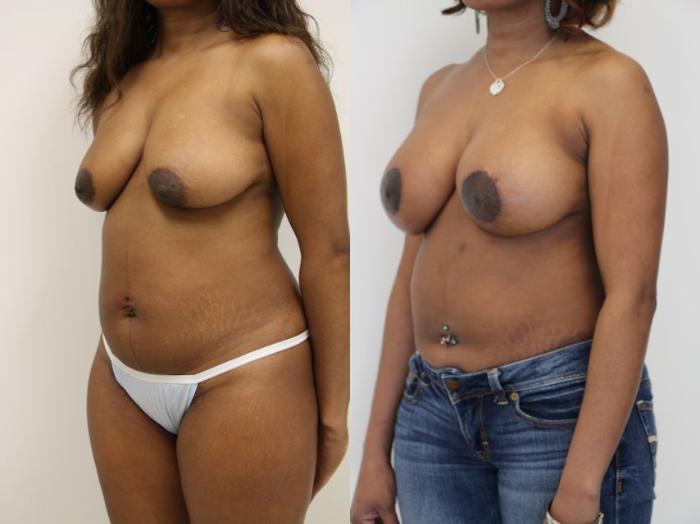 Before & After Breast Augmentation Case 26 View #2 View in Gilbert, AZ