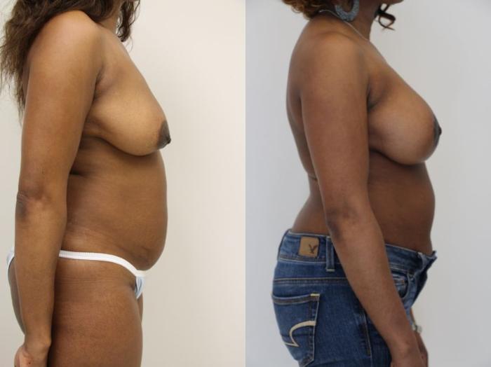 Before & After Breast Augmentation Case 26 View #3 View in Gilbert, AZ