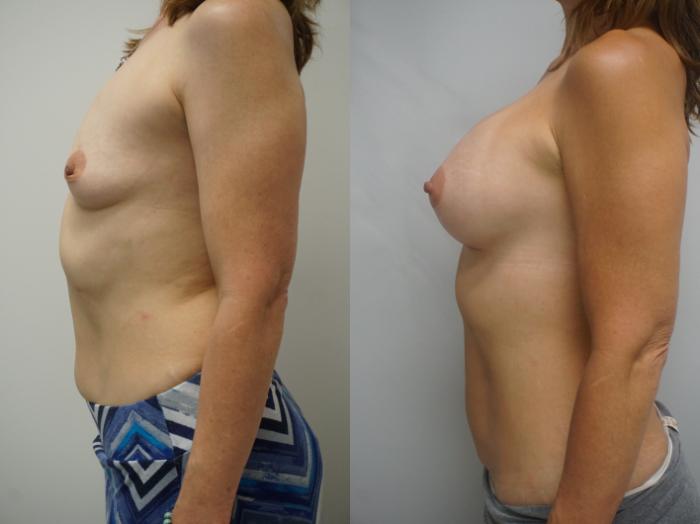 Before & After Breast Augmentation Case 260 View #1 View in Gilbert, AZ
