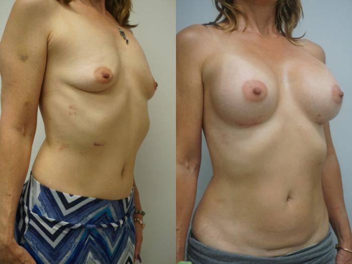 Before & After Breast Augmentation Case 260 View #2 View in Gilbert, AZ