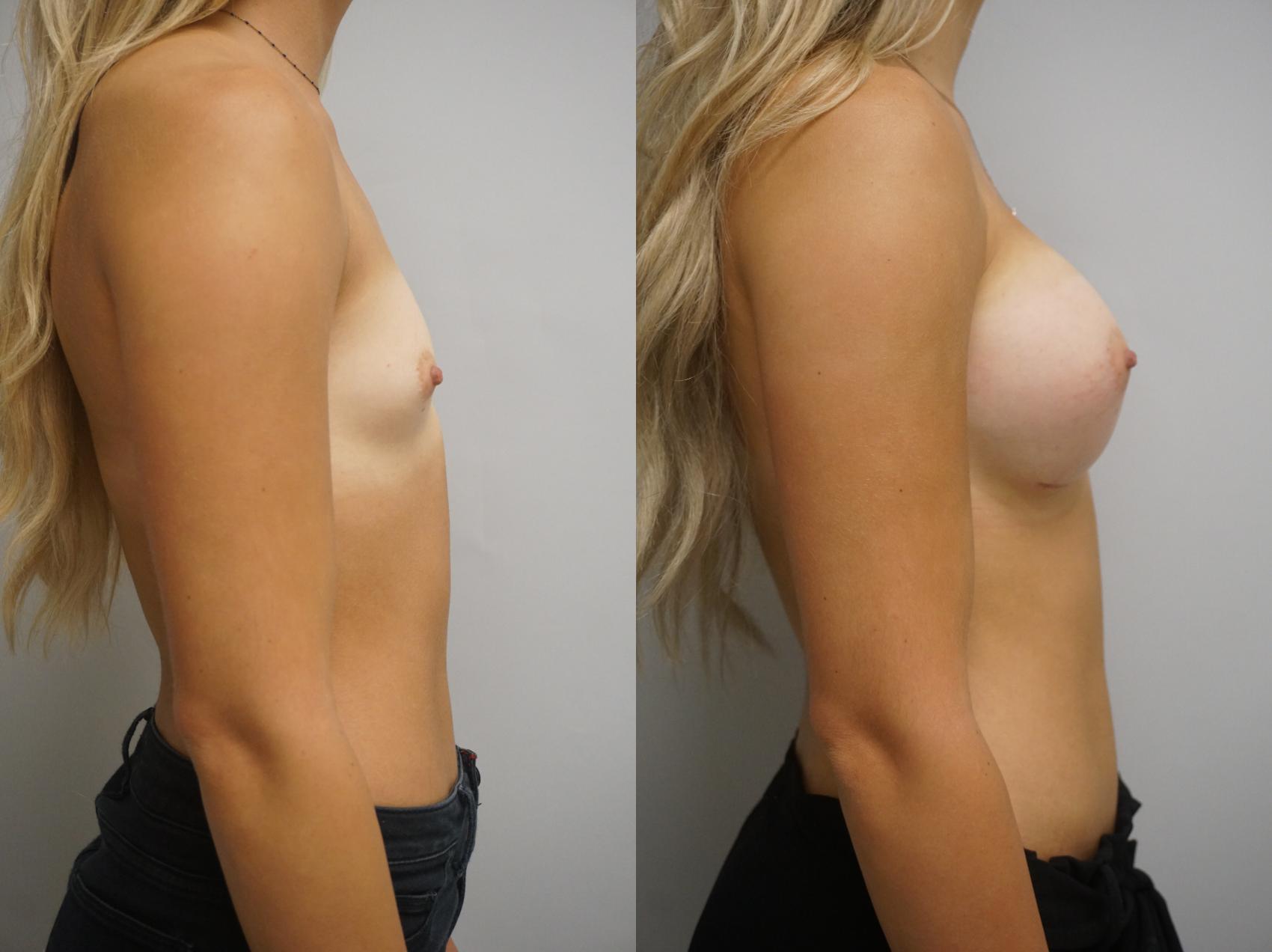 Before & After Breast Augmentation Case 261 View #1 View in Gilbert, AZ