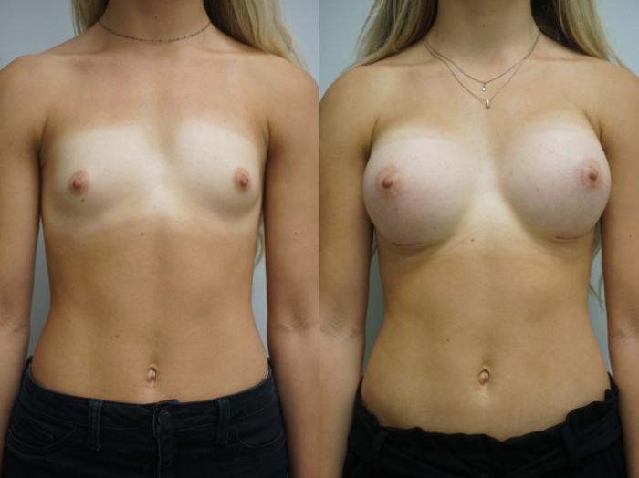 Before & After Breast Augmentation Case 261 View #2 View in Gilbert, AZ