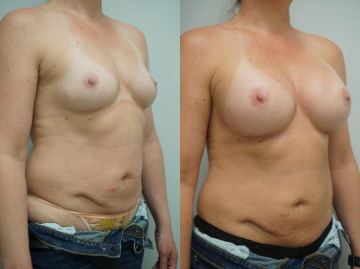 Before & After Breast Augmentation Case 264 View #1 View in Gilbert, AZ