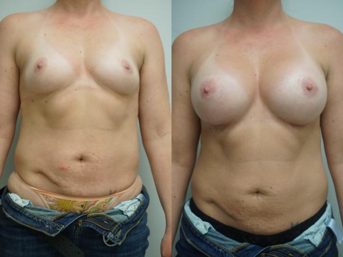 Before & After Breast Augmentation Case 264 View #2 View in Gilbert, AZ