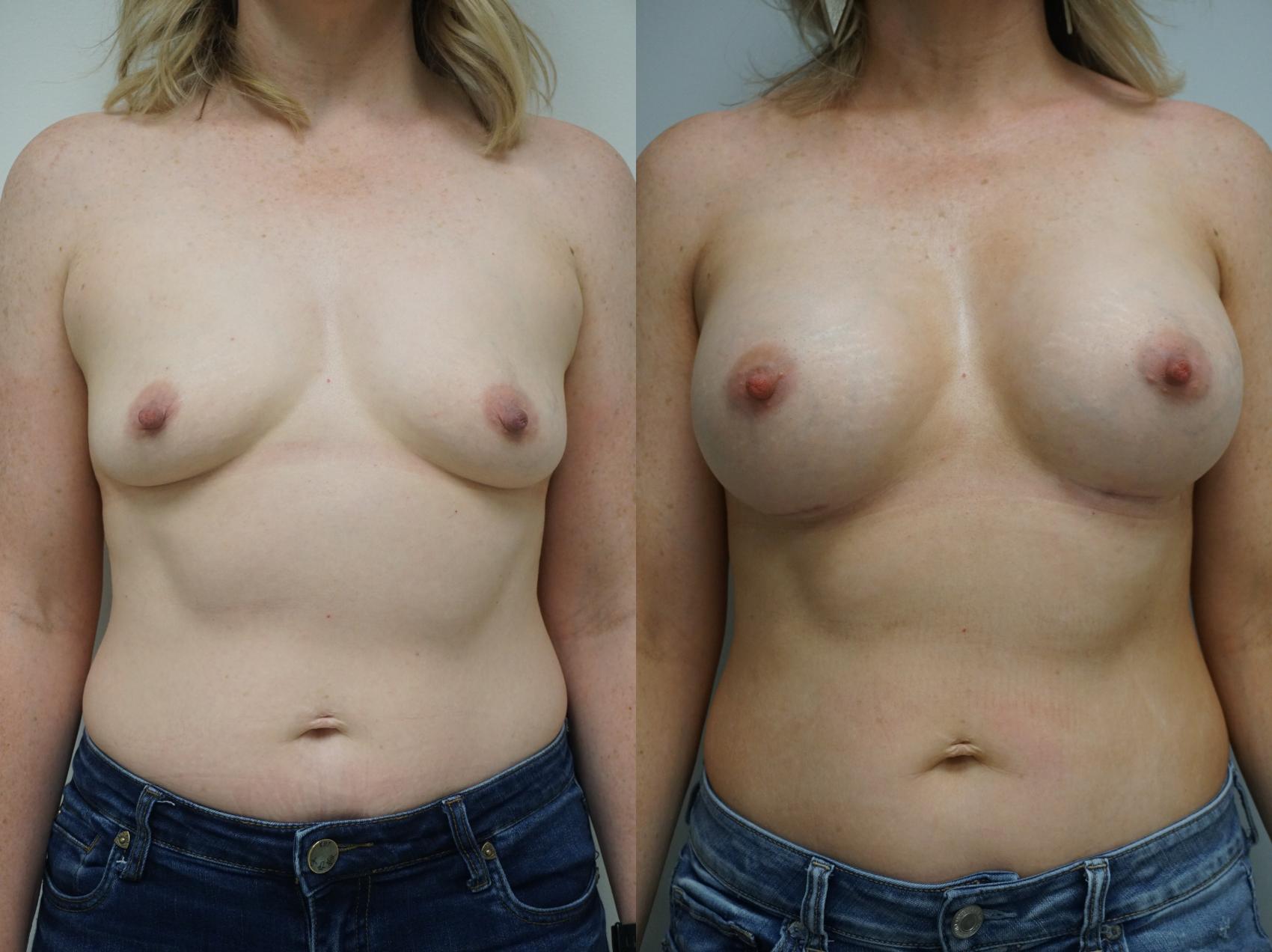 Before & After Breast Augmentation Case 265 View #1 View in Gilbert, AZ