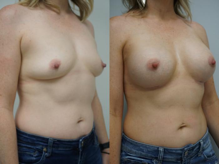 Before & After Breast Augmentation Case 265 View #2 View in Gilbert, AZ