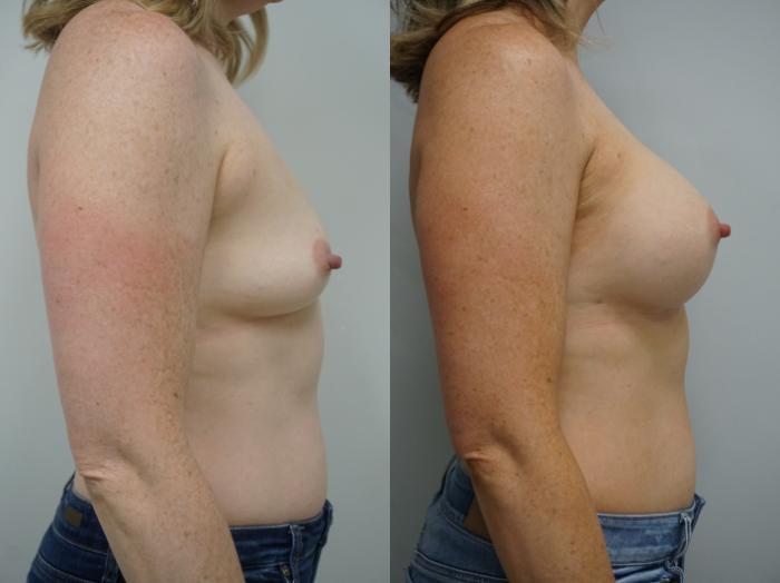 Before & After Breast Augmentation Case 265 View #3 View in Gilbert, AZ