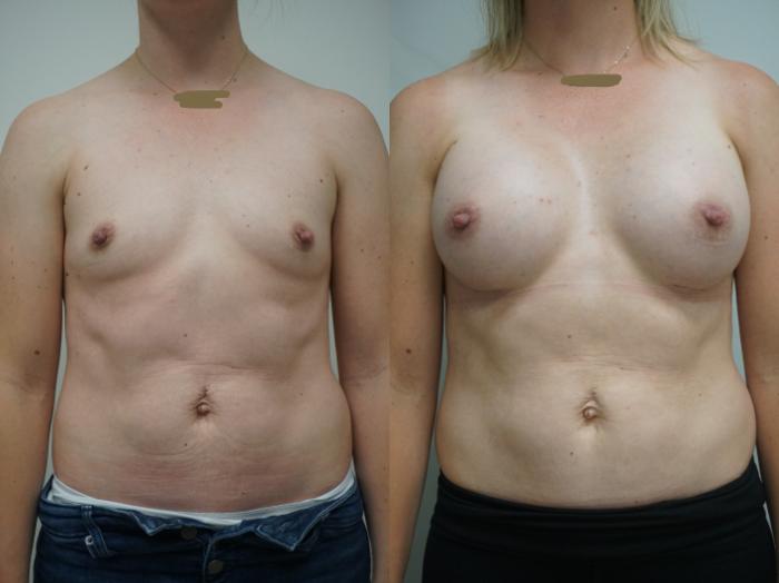 Before & After Breast Augmentation Case 269 View #1 View in Gilbert, AZ
