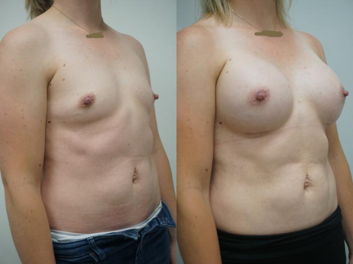 Before & After Breast Augmentation Case 269 View #2 View in Gilbert, AZ