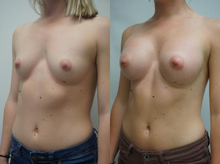 Before & After Breast Augmentation Case 270 View #2 View in Gilbert, AZ