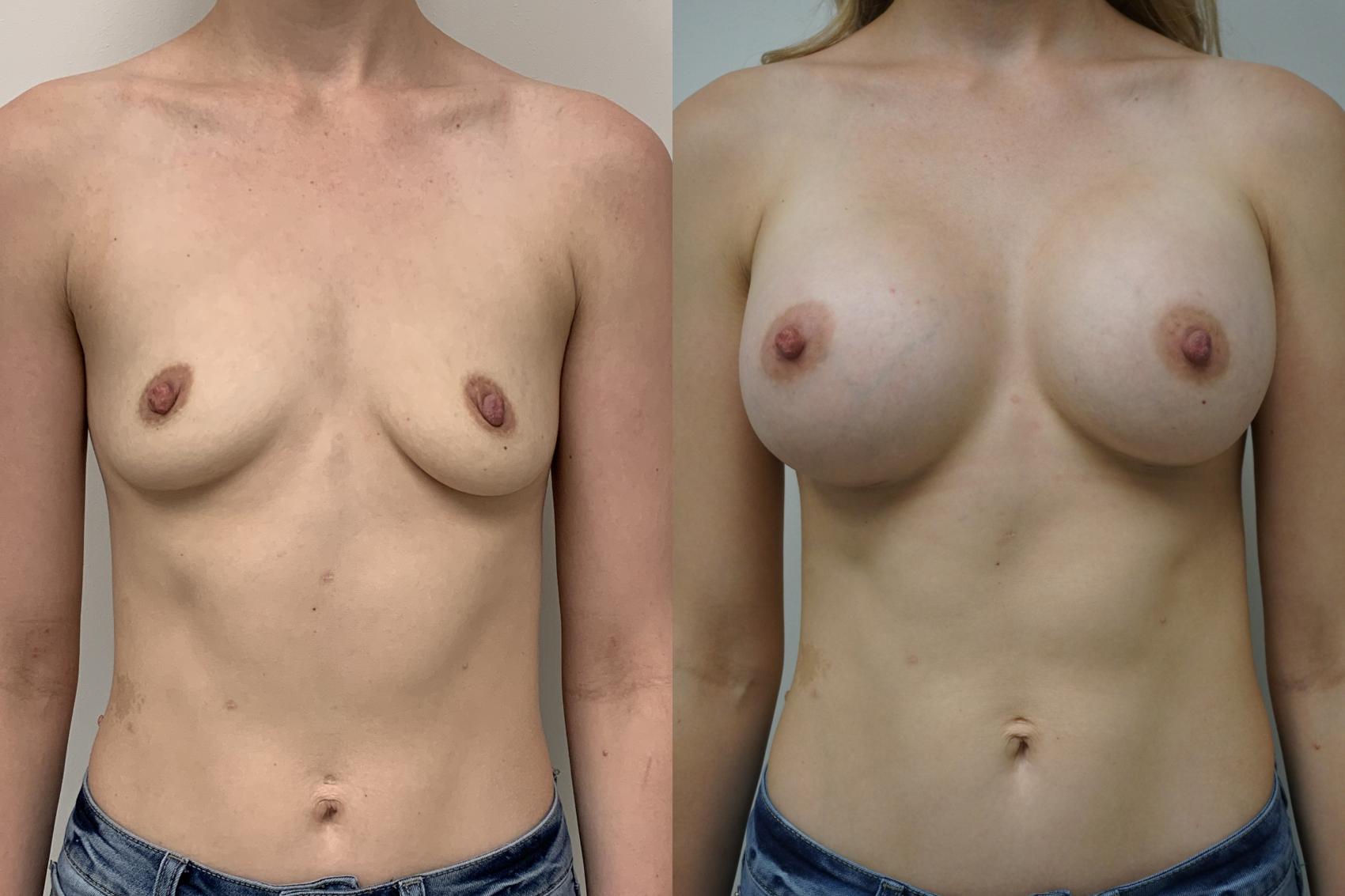 Before & After Breast Augmentation Case 278 Front View in Gilbert, AZ