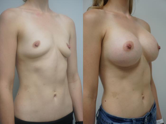 Before & After Breast Augmentation Case 278 Right Oblique View in Gilbert, AZ