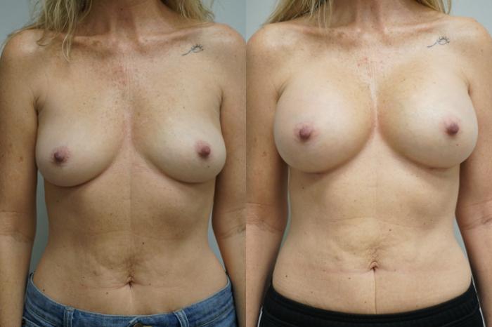 Before & After Breast Augmentation Case 280 Front View in Gilbert, AZ