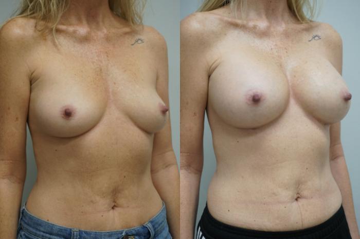 Before & After Breast Augmentation Case 280 Right Oblique View in Gilbert, AZ