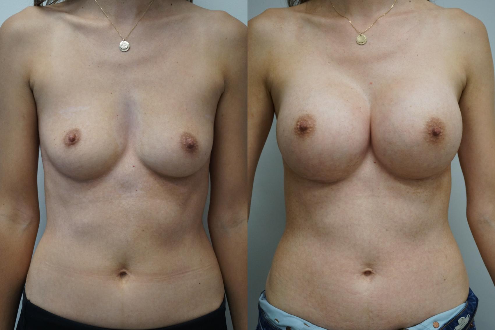 Before & After Breast Augmentation Case 283 Front View in Gilbert, AZ
