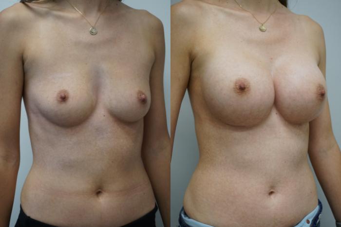 Before & After Breast Augmentation Case 283 Right Oblique View in Gilbert, AZ