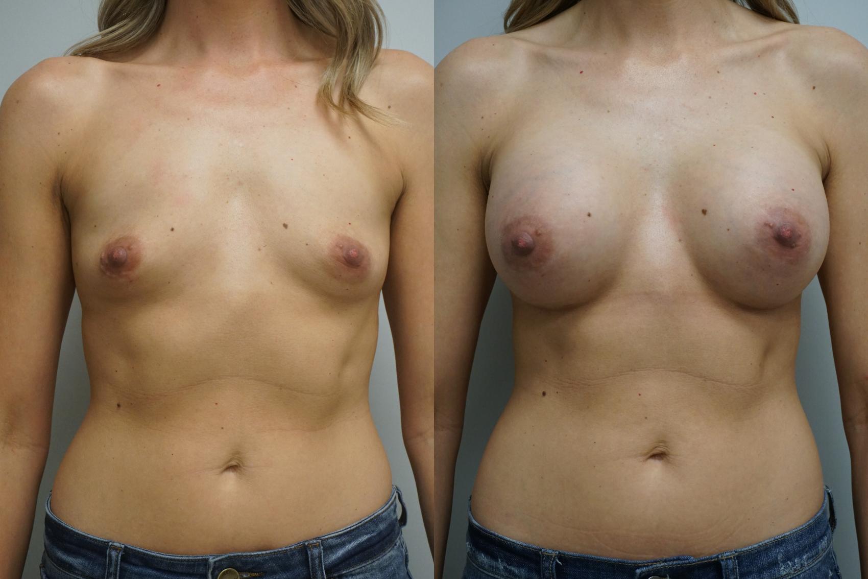 Before & After Breast Augmentation Case 286 Front View in Gilbert, AZ