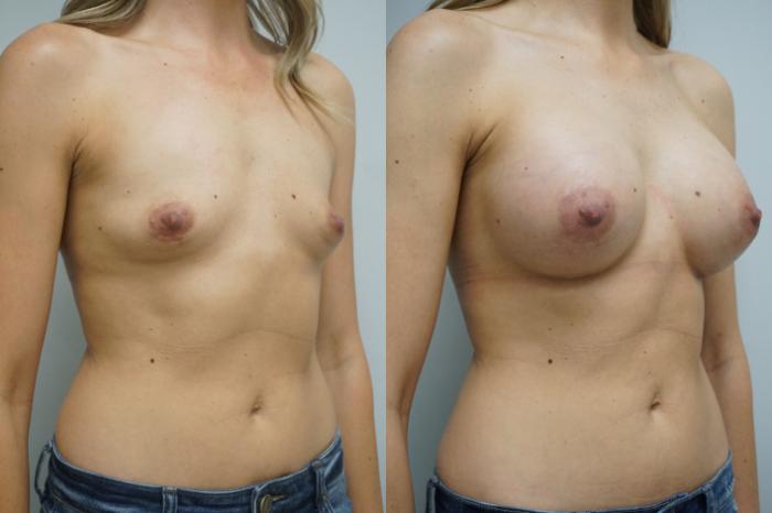 Before & After Breast Augmentation Case 286 Right Side View in Gilbert, AZ