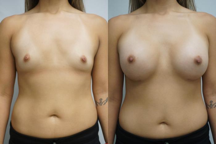 Before & After Breast Augmentation Case 288 Front View in Gilbert, AZ