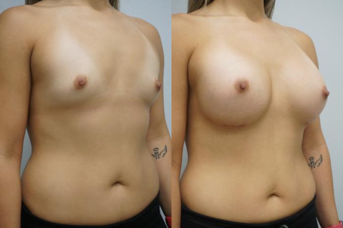 Before & After Breast Augmentation Case 288 Right Oblique View in Gilbert, AZ