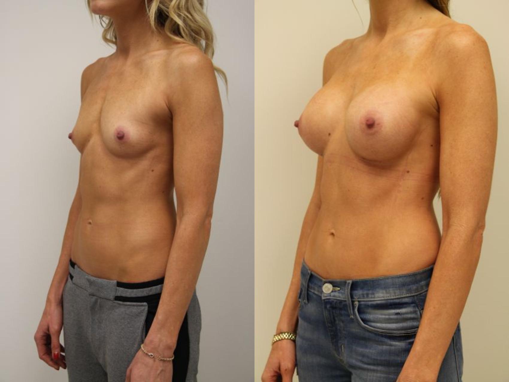 Before & After Breast Augmentation Case 29 View #1 View in Gilbert, AZ
