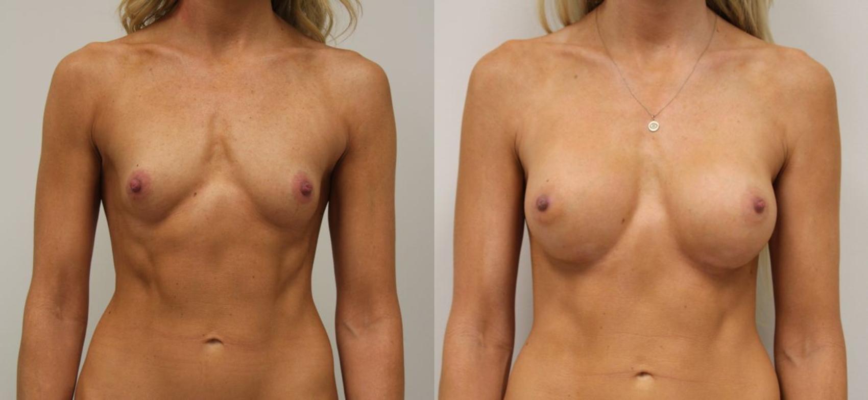 Before & After Breast Augmentation Case 29 View #2 View in Gilbert, AZ