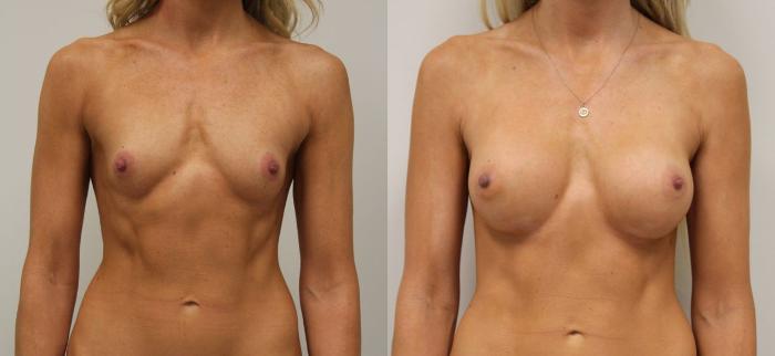 Before & After Breast Augmentation Case 29 View #2 View in Gilbert, AZ