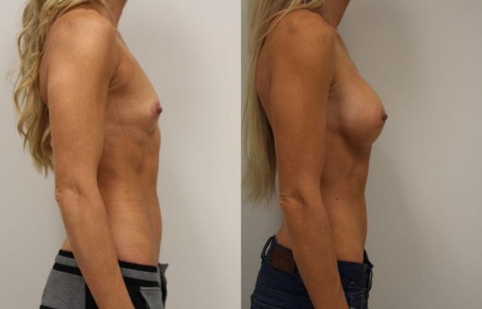 Before & After Breast Augmentation Case 29 View #3 View in Gilbert, AZ