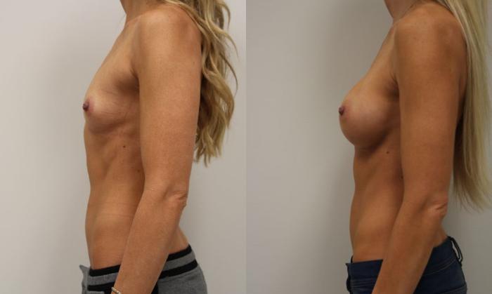 Before & After Breast Augmentation Case 29 View #4 View in Gilbert, AZ