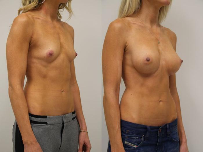 Before & After Breast Augmentation Case 29 View #5 View in Gilbert, AZ